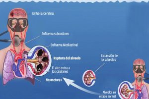decompression-sickness-efects